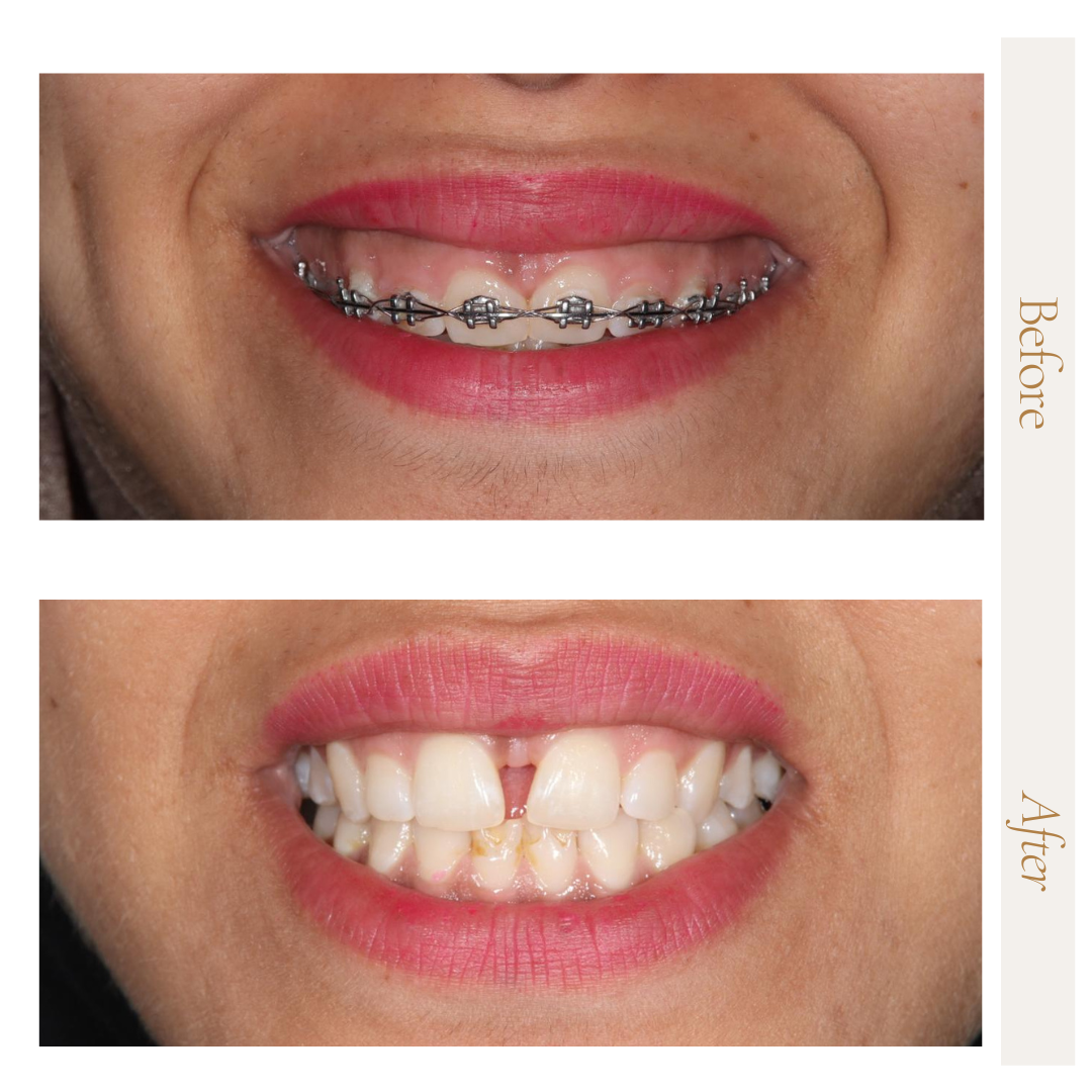 تقويم الأسنان